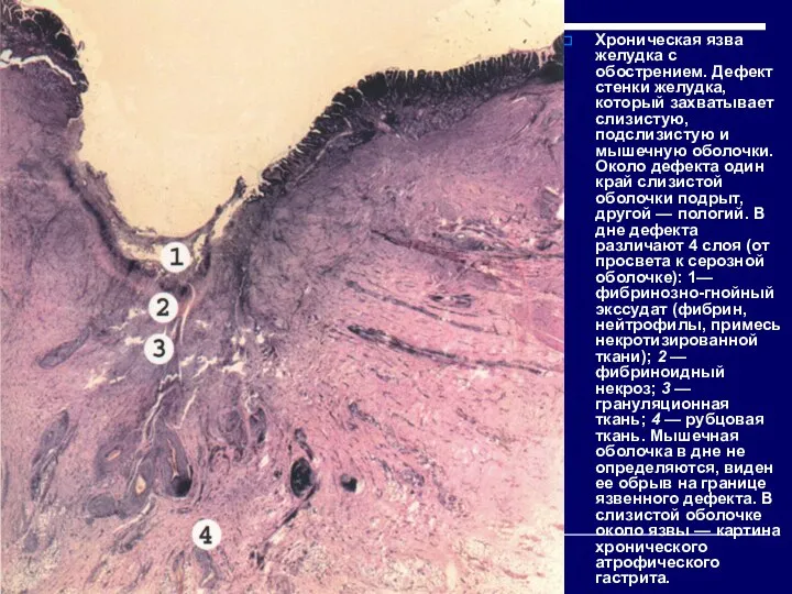Хроническая язва желудка с обострением. Дефект стенки желудка, который захватывает слизистую, подслизистую