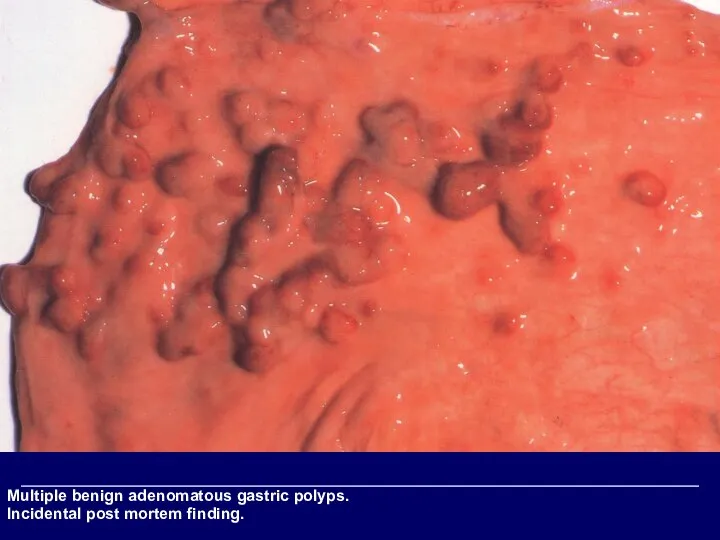 Multiple benign adenomatous gastric polyps. Incidental post mortem finding.