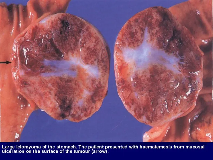 Large leiomyoma of the stomach. The patient presented with haematemesis from mucosal