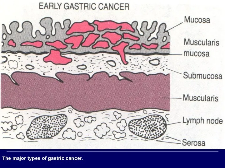 The major types of gastric cancer.