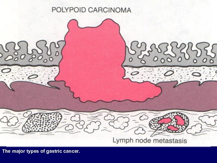 The major types of gastric cancer.