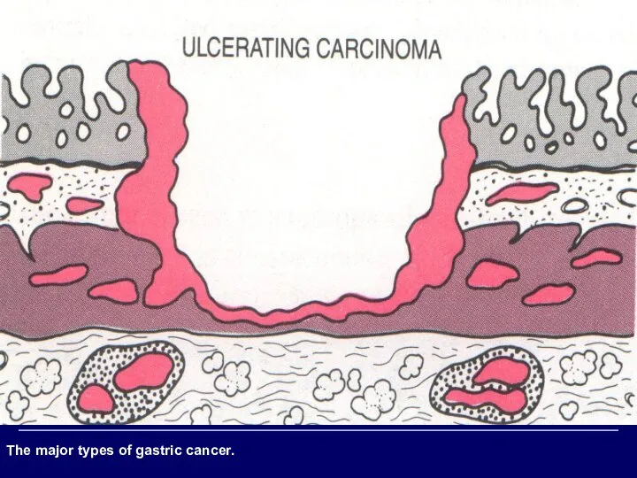 The major types of gastric cancer.