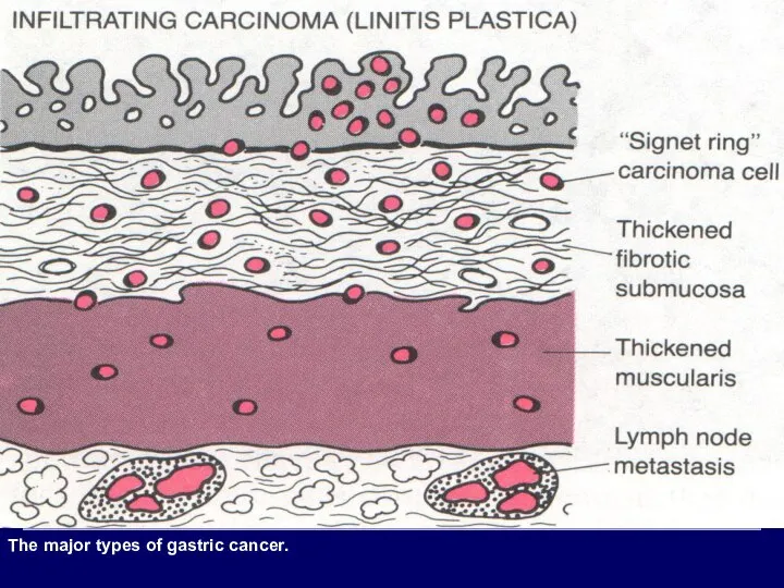 The major types of gastric cancer.