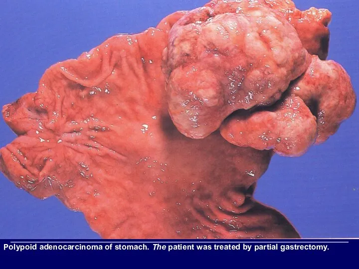 Polypoid adenocarcinoma of stomach. The patient was treated by partial gastrectomy.