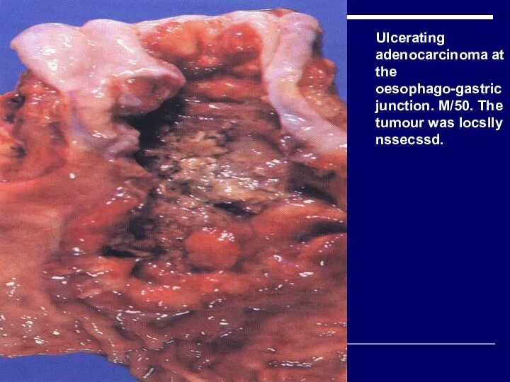 Ulcerating adenocarcinoma at the oesophago-gastric junction. M/50. The tumour was locslly nssecssd.