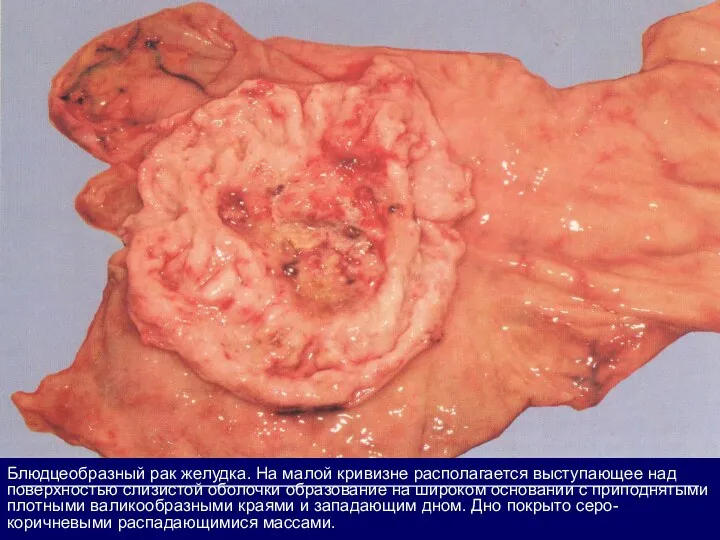 Блюдцеобразный рак желудка. На малой кривизне располагается выступающее над поверхностью слизистой оболочки