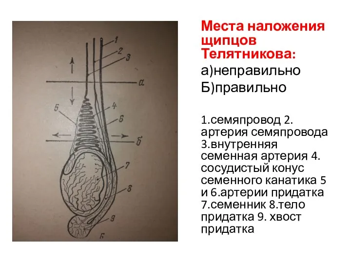 Места наложения щипцов Телятникова: а)неправильно Б)правильно 1.семяпровод 2.артерия семяпровода 3.внутренняя семенная артерия