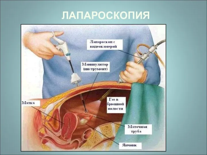 ЛАПАРОСКОПИЯ