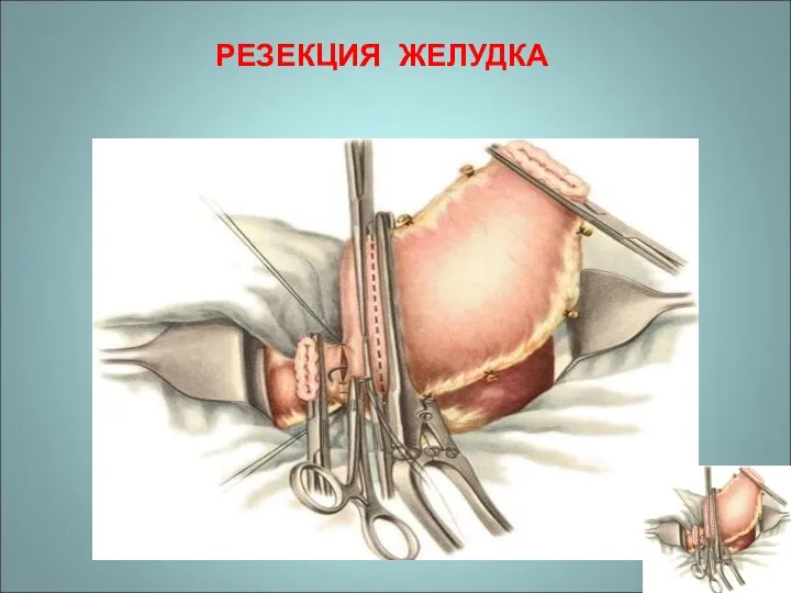 РЕЗЕКЦИЯ ЖЕЛУДКА