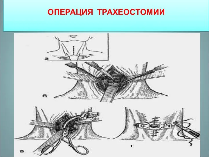 ОПЕРАЦИЯ ТРАХЕОСТОМИИ