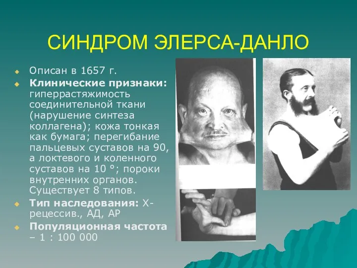 СИНДРОМ ЭЛЕРСА-ДАНЛО Описан в 1657 г. Клинические признаки: гиперрастяжимость соединительной ткани (нарушение