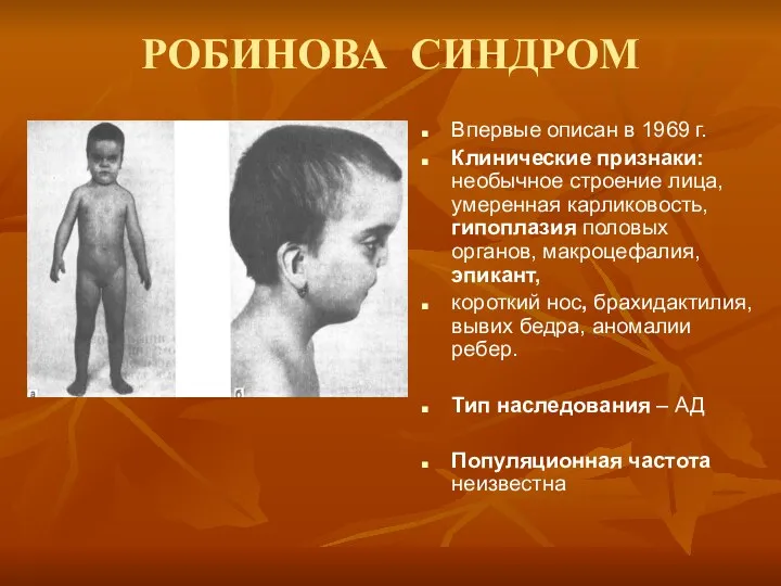 РОБИНОВА СИНДРОМ Впервые описан в 1969 г. Клинические признаки: необычное строение лица,