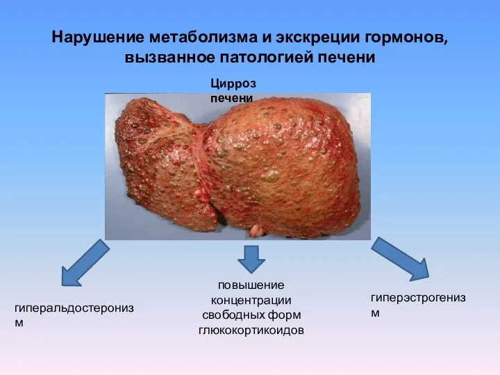 Нарушение метаболизма и экскреции гормонов, вызванное патологией печени гиперальдостеронизм гиперэстрогенизм повышение концентрации