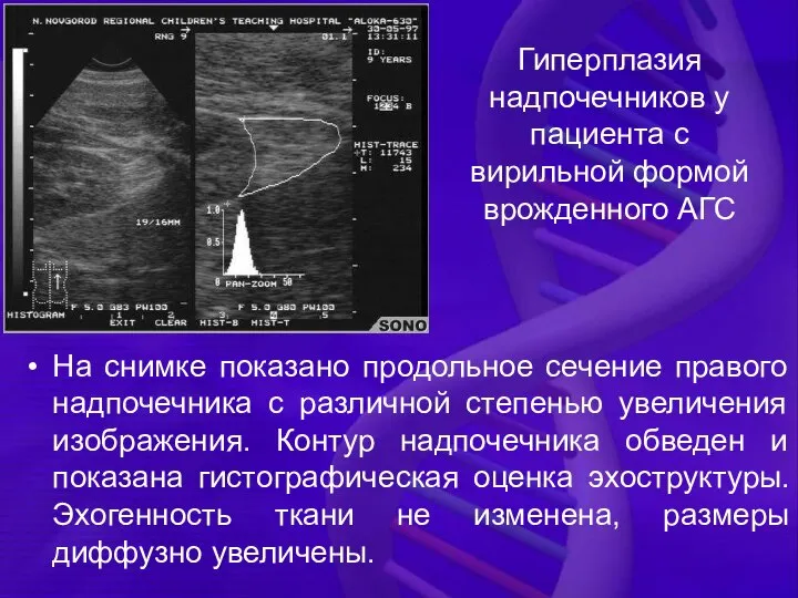 Гиперплазия надпочечников у пациента с вирильной формой врожденного АГС На снимке показано