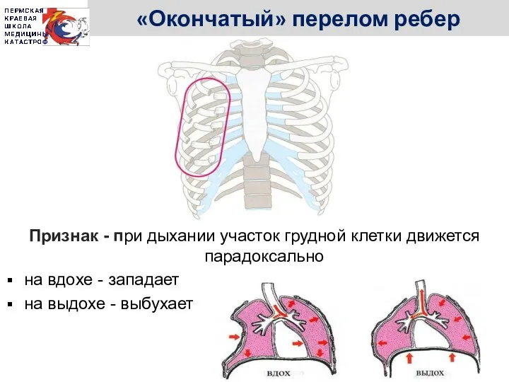 «Окончатый» перелом ребер Признак - при дыхании участок грудной клетки движется парадоксально
