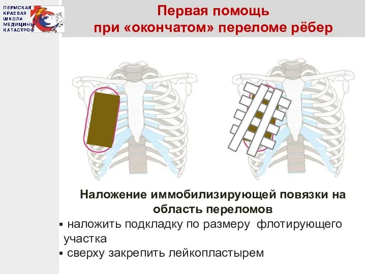 Первая помощь при «окончатом» переломе рёбер Наложение иммобилизирующей повязки на область переломов