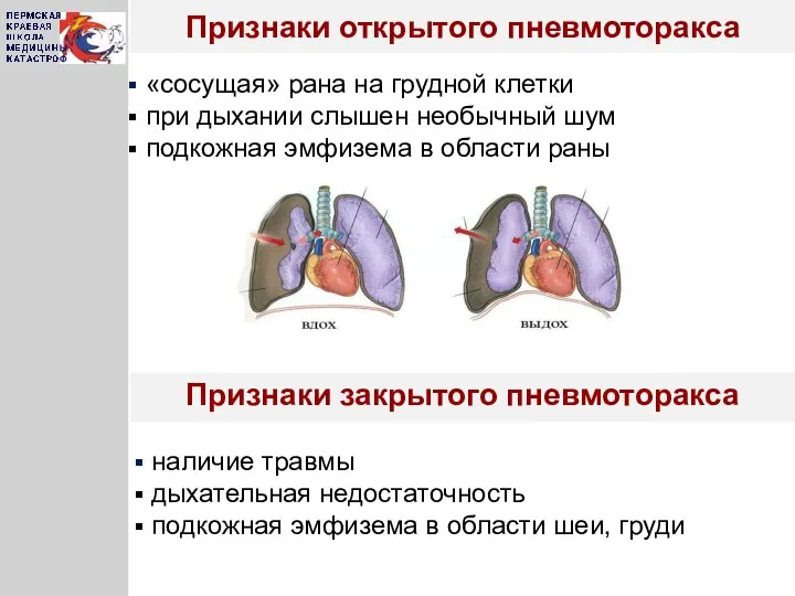 Признаки открытого пневмоторакса Признаки закрытого пневмоторакса «сосущая» рана на грудной клетки при