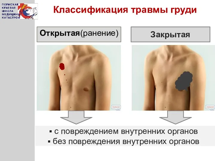 Классификация травмы груди Открытая(ранение) с повреждением внутренних органов без повреждения внутренних органов Закрытая