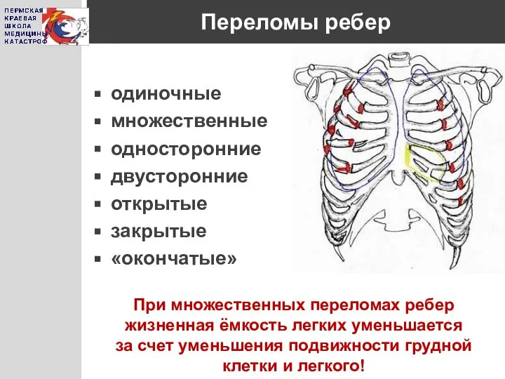 Переломы ребер одиночные множественные односторонние двусторонние открытые закрытые «окончатые» При множественных переломах