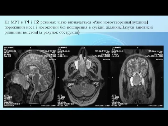 На МРТ в Т1 і Т2 режимах чітко визначається м‘яке новоутворення(пухлина) порожнини