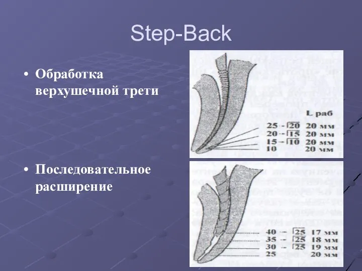 Step-Back Обработка верхушечной трети Последовательное расширение