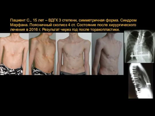 Пациент С., 15 лет – ВДГК 3 степени, симметричная форма. Синдром Марфана.