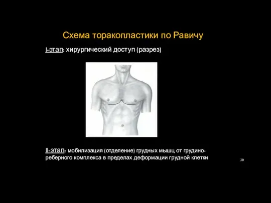 Схема торакопластики по Равичу I-этап: хирургический доступ (разрез) II-этап: мобилизация (отделение) грудных