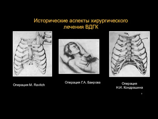 Исторические аспекты хирургического лечения ВДГК Операция M. Ravitch Операция Г.А. Баирова Операция Н.И. Кондрашина
