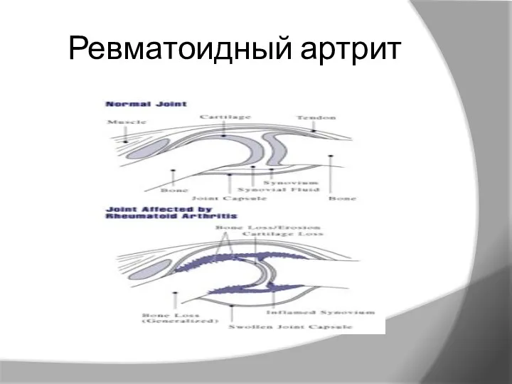 Ревматоидный артрит