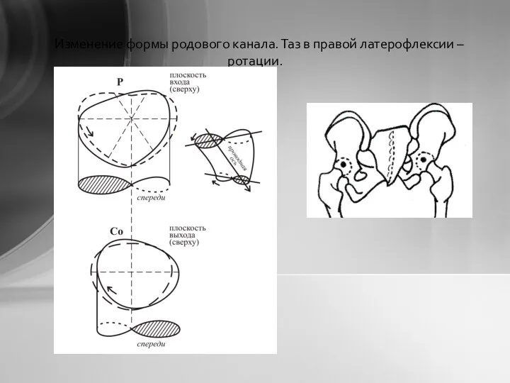 Изменение формы родового канала. Таз в правой латерофлексии – ротации.