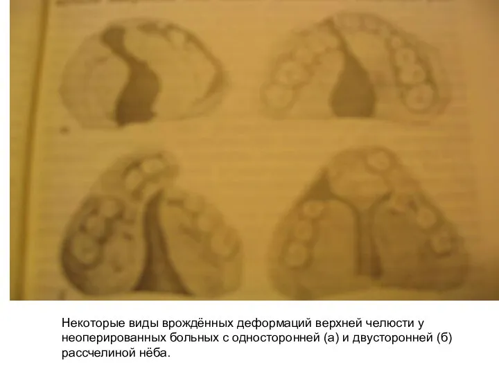 Некоторые виды врождённых деформаций верхней челюсти у неоперированных больных с односторонней (а)