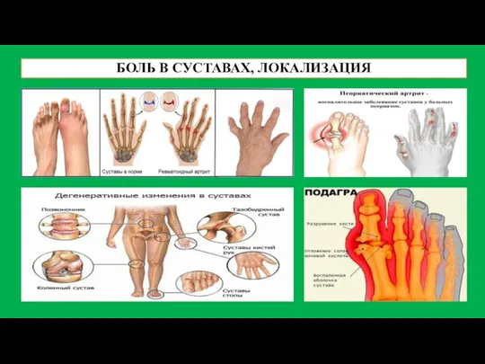 БОЛЬ В СУСТАВАХ, ЛОКАЛИЗАЦИЯ