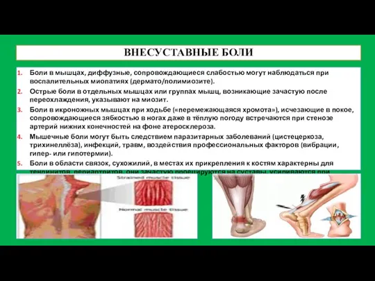 ВНЕСУСТАВНЫЕ БОЛИ Боли в мышцах, диффузные, сопровождающиеся слабостью могут наблюдаться при воспалительных