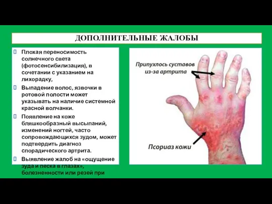 ДОПОЛНИТЕЛЬНЫЕ ЖАЛОБЫ Плохая переносимость солнечного света (фотосенсибилизация), в сочетании с указанием на