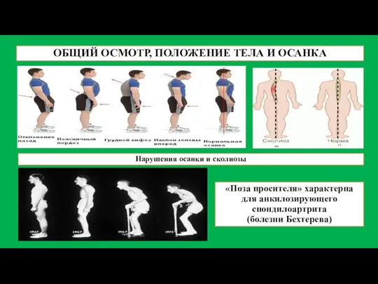 ОБЩИЙ ОСМОТР, ПОЛОЖЕНИЕ ТЕЛА И ОСАНКА «Поза просителя» характерна для анкилозирующего спондилоартрита