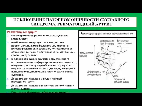 ИСКЛЮЧЕНИЕ ПАТОГНОМОНИЧНОСТИ СУСТАВНОГО СИНДРОМА, РЕВМАТОИДНЫЙ АРТРИТ Ревматоидный артрит: симметричное поражение мелких суставов