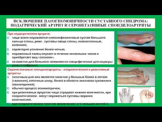 ИСКЛЮЧЕНИЕ ПАТОГНОМОНИЧНОСТИ СУСТАВНОГО СИНДРОМА: ПОДАГРИЧЕСКИЙ АРТРИТ И СЕРОНЕГАТИВНЫЕ СПОНДИЛОАРТРИТЫ При подагрическом артрите: