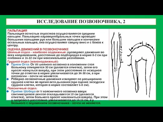 ИССЛЕДОВАНИЕ ПОЗВОНОЧНИКА, 2 ПАЛЬПАЦИЯ Пальпация остистых отростков осуществляется средним пальцем. Пальпацию паравертебральных