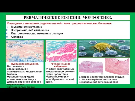 РЕВМАТИЧЕСКИЕ БОЛЕЗНИ. МОРФОГЕНЕЗ. Фазы дезорганизации соединительной ткани при ревматических болезнях: Мукоидное набухание