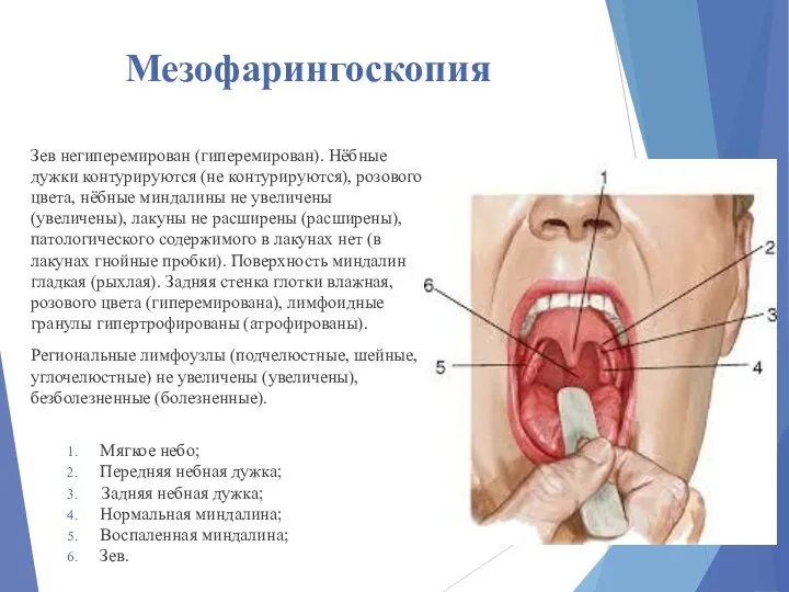 Мезофарингоскопия Зев негиперемирован (гиперемирован). Нёбные дужки контурируются (не контурируются), розового цвета, нёбные