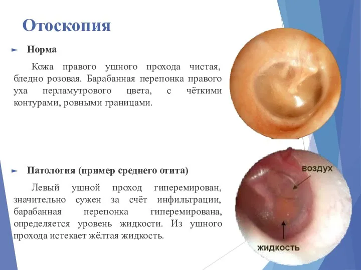 Отоскопия Норма Кожа правого ушного прохода чистая, бледно розовая. Барабанная перепонка правого