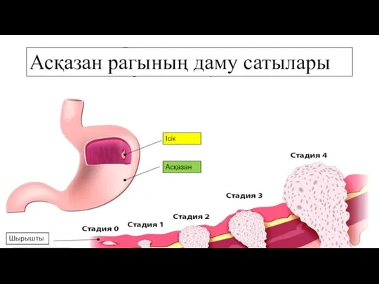 Асқазан рагының даму сатылары Ісік Асқазан Шырышты Шырыш асты Бұлшықет Сыртқы серозды қабат Ісік