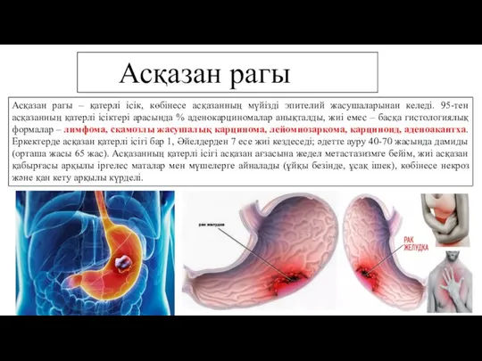 Асқазан рагы Асқазан рагы – қатерлі ісік, көбінесе асқазанның мүйізді эпителий жасушаларынан