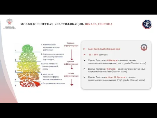 МОРФОЛОГИЧЕСКАЯ КЛАССИФИКАЦИЯ. ШКАЛА ГЛИСОНА Ацинарная аденокарцинома 85 – 90% случаев Сумма Глисона