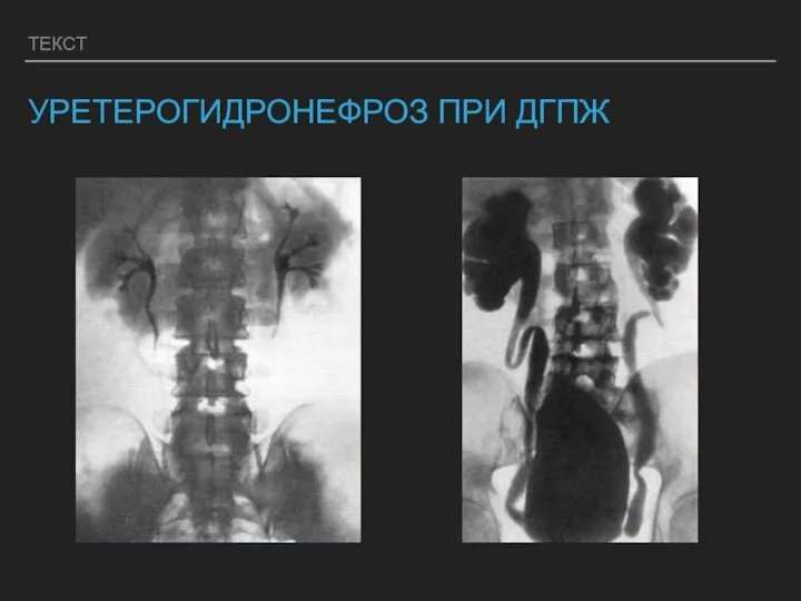 ТЕКСТ УРЕТЕРОГИДРОНЕФРОЗ ПРИ ДГПЖ