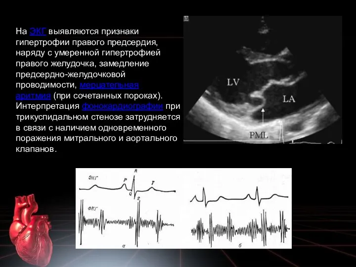 На ЭКГ выявляются признаки гипертрофии правого предсердия, наряду с умеренной гипертрофией правого