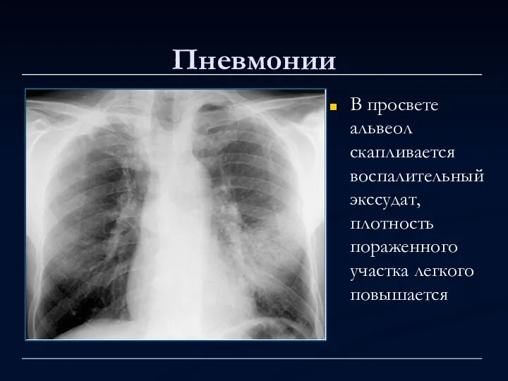 Пневмонии В просвете альвеол скапливается воспалительный экссудат, плотность пораженного участка легкого повышается