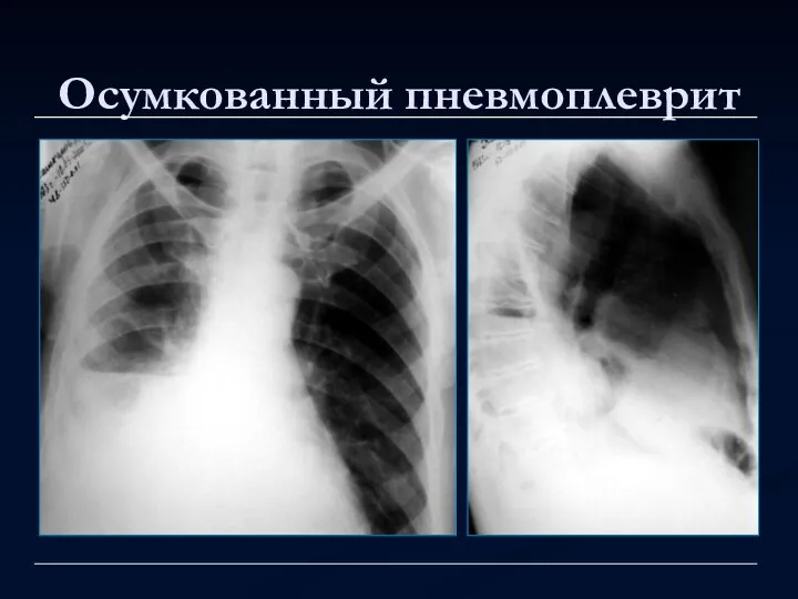 Осумкованный пневмоплеврит