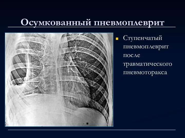 Осумкованный пневмоплеврит Ступенчатый пневмоплеврит после травматического пневмоторакса