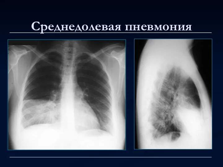 Среднедолевая пневмония